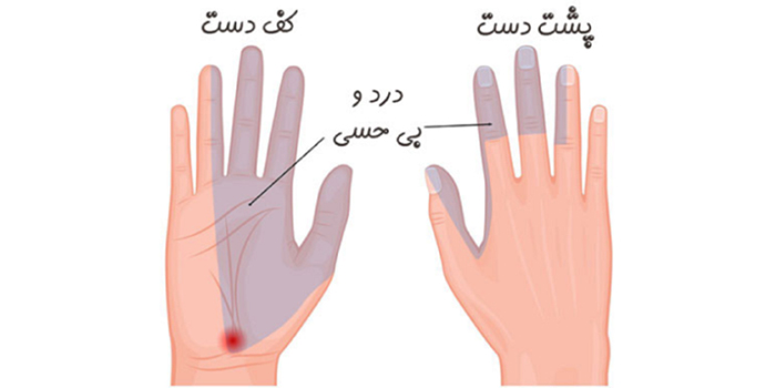 علائم سندروم