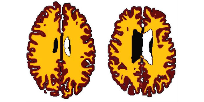 مغز افراد چاق ۱۰ سال پیرتر از سایر افراد است